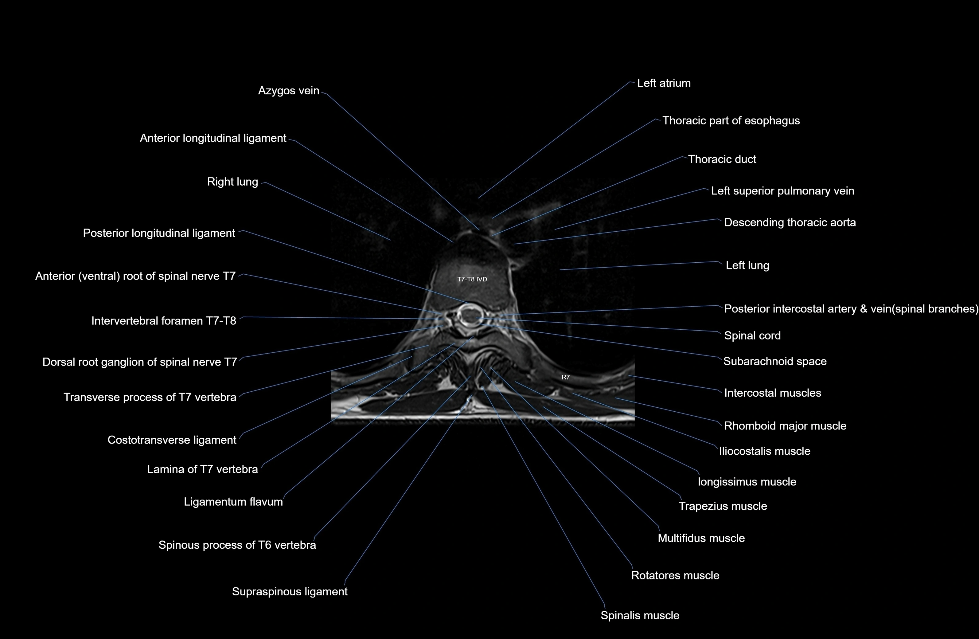 MRI thoracic spine axial  cross sectional anatomy 3T radiology  image-img-00001-00047.webp